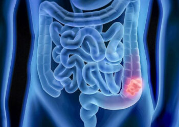 Aumenta número de casos de câncer de cólon em jovens adultos