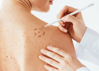 Veja quando uma mancha escura na pele pode ser sinal de câncer